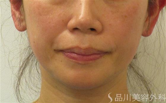 症例NO.58819のBEFORE写真