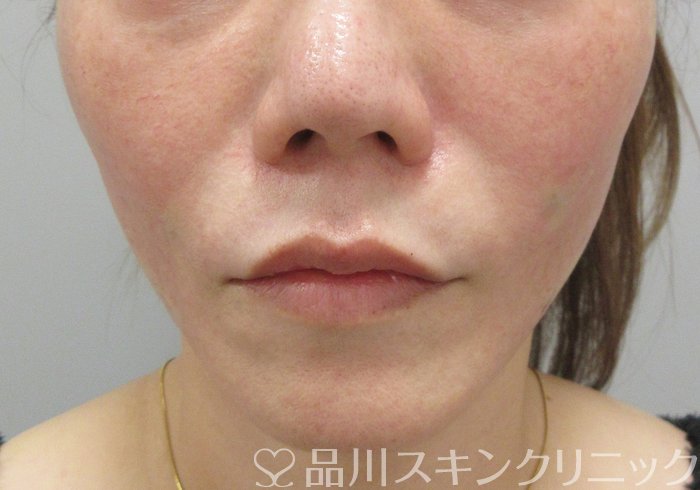 症例NO.69943のAFTER写真
