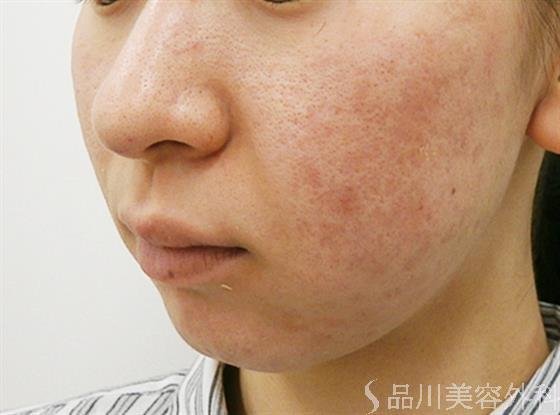 症例NO.40748のBEFORE写真