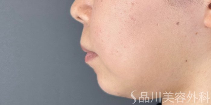 症例NO.72415のAFTER写真