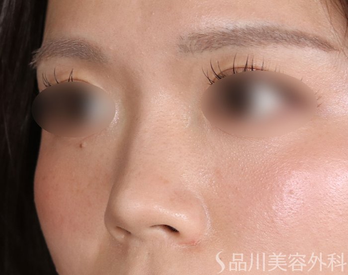 症例NO.73796のBEFORE写真
