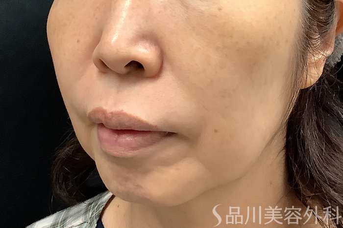 症例NO.71257のBEFORE写真