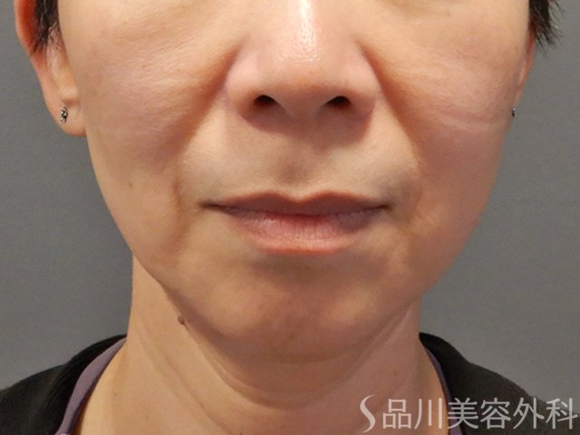症例NO.74312のBEFORE写真