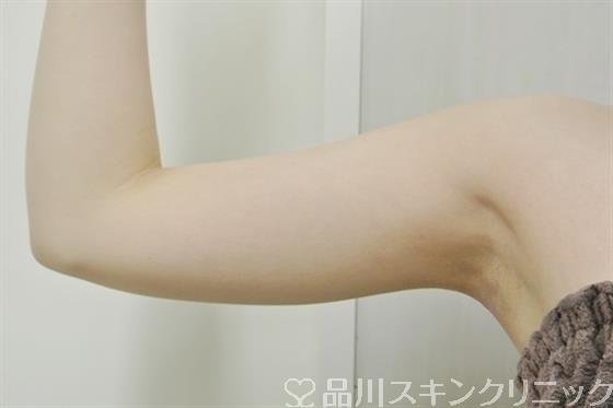 症例NO.35422のAFTER写真