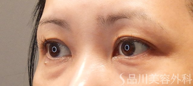 症例NO.71713のBEFORE写真