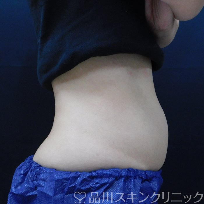 症例NO.65614のBEFORE写真