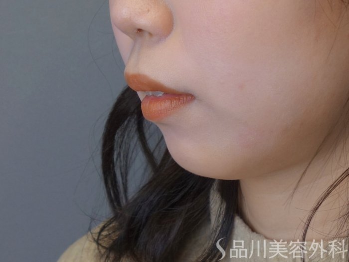 症例NO.72579のBEFORE写真