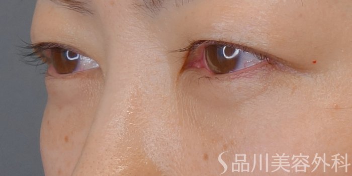 症例NO.72943のAFTER写真