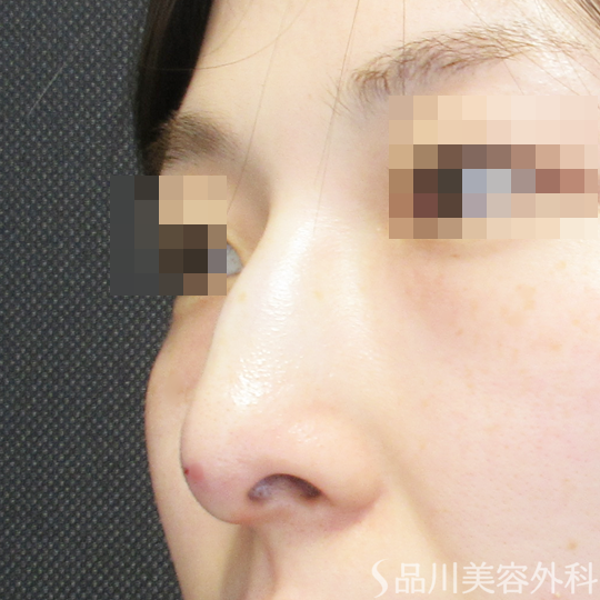 症例NO.69927のAFTER写真