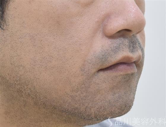 症例NO.43957のBEFORE写真
