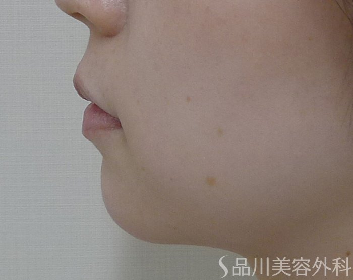 症例NO.73407のBEFORE写真