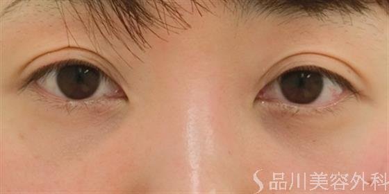 症例NO.26319のAFTER写真