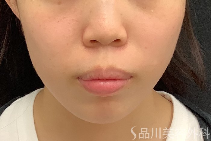 症例NO.71585のBEFORE写真