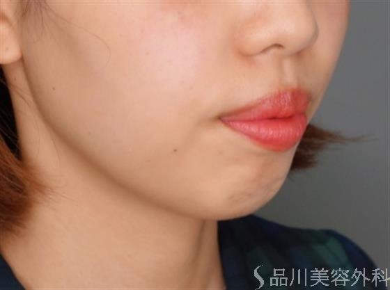 症例NO.52312のBEFORE写真