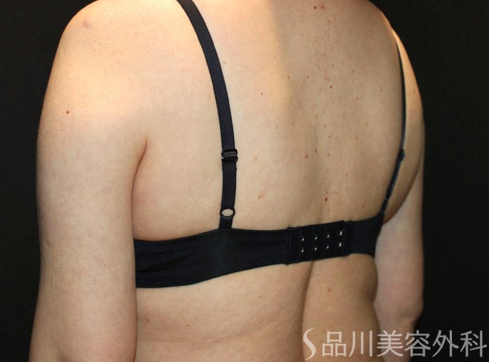 症例NO.72047のAFTER写真