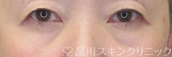 症例NO.71394のAFTER写真