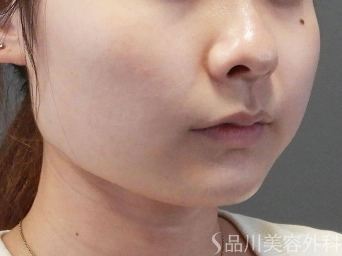 症例NO.70046のBEFORE写真