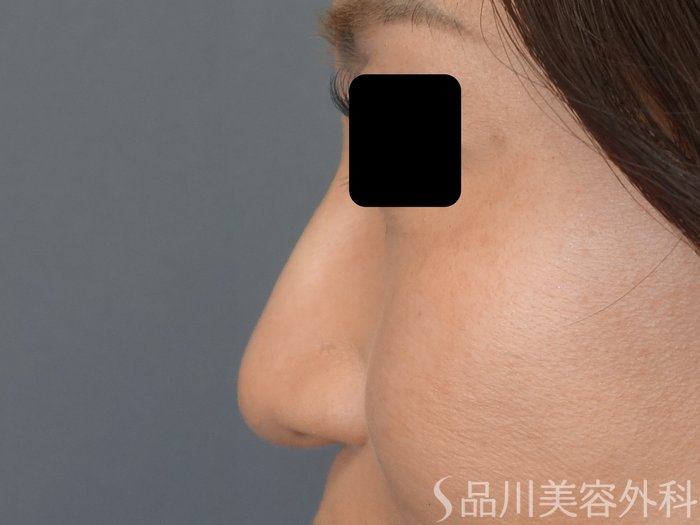 症例NO.69357のAFTER写真