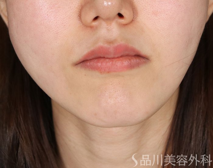 症例NO.74051のAFTER写真
