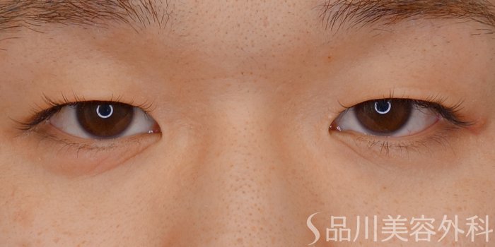 症例NO.72581のBEFORE写真