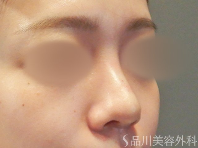 症例NO.65617のAFTER写真