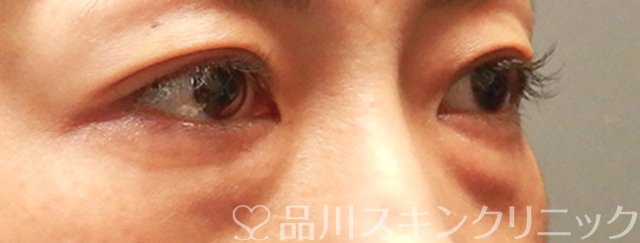 症例NO.66353のBEFORE写真