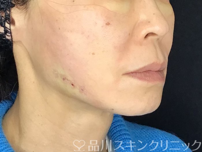 症例NO.69593のAFTER写真