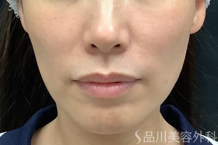 症例NO.71531のBEFORE写真