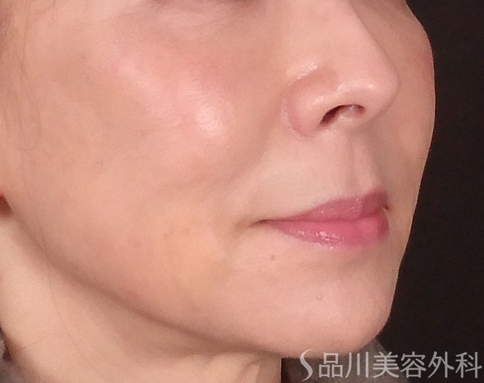 症例NO.69735のAFTER写真