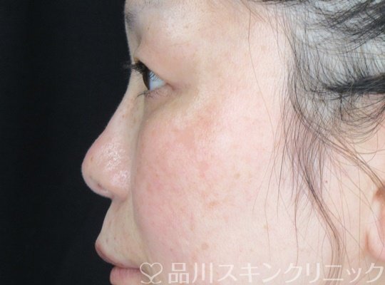 症例NO.69728のAFTER写真