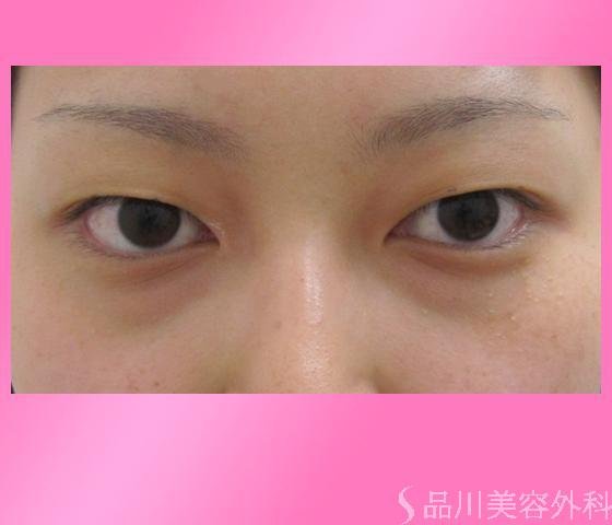 症例NO.2427のBEFORE写真