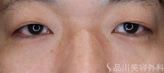 症例NO.58956のBEFORE写真