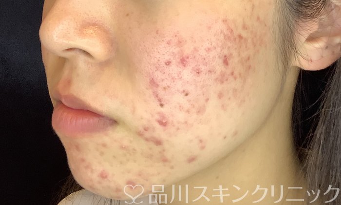 症例NO.72788のBEFORE写真