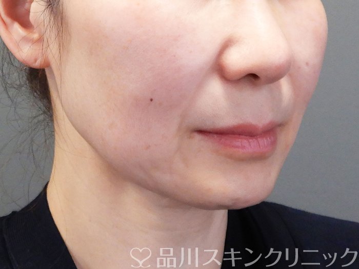 症例NO.74103のBEFORE写真