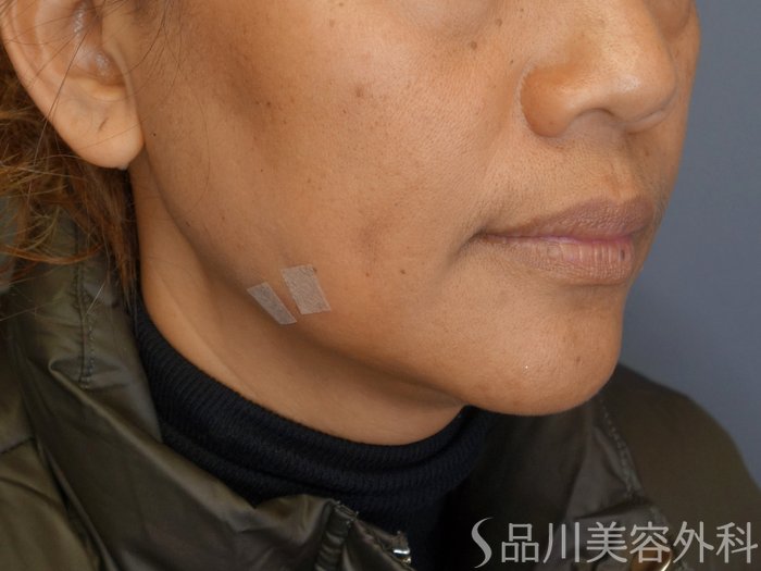 症例NO.72276のAFTER写真