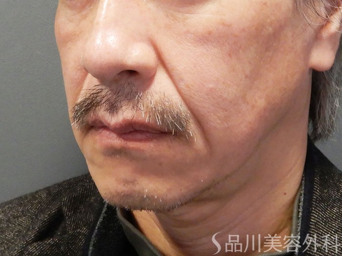 症例NO.70468のBEFORE写真