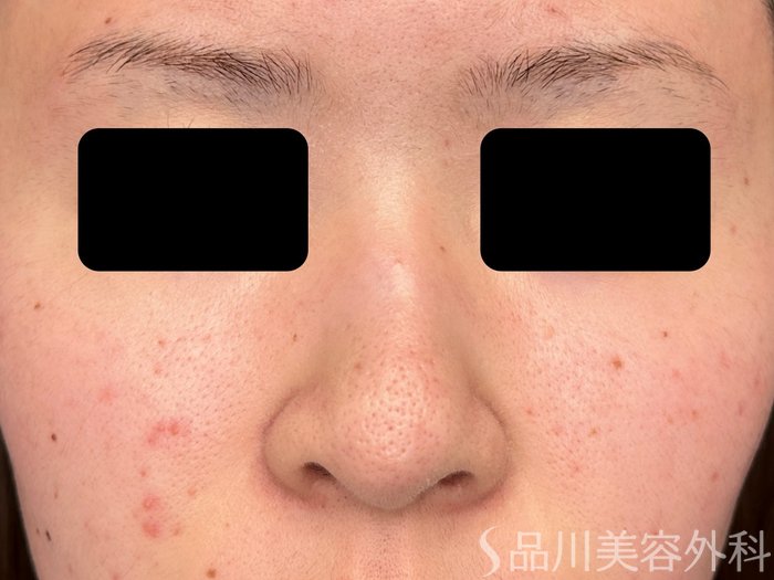 症例NO.74868のBEFORE写真