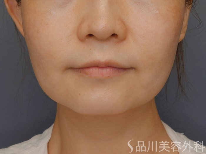症例NO.71850のBEFORE写真