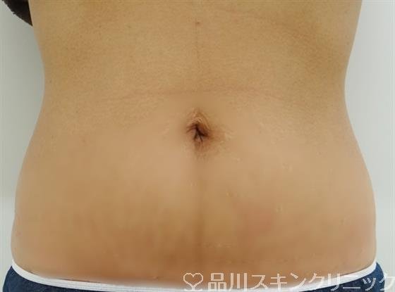 症例NO.28851のAFTER写真