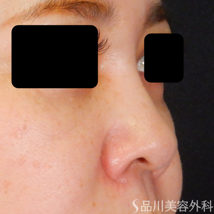 症例NO.69310のBEFORE写真