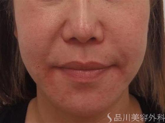 症例NO.2485のBEFORE写真