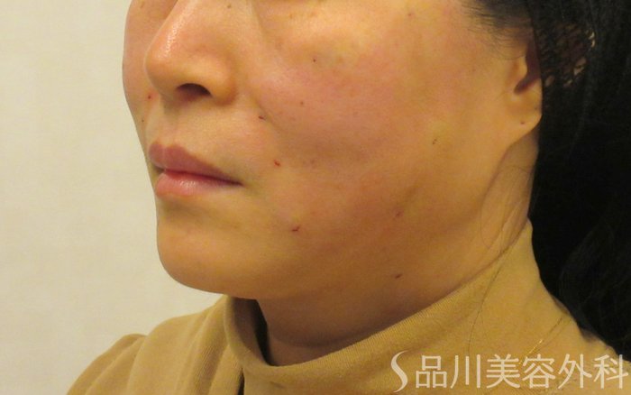 症例NO.73700のAFTER写真