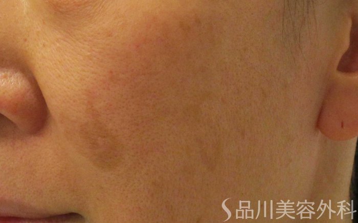 症例NO.70850のBEFORE写真