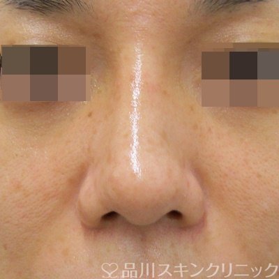 症例NO.71707のAFTER写真