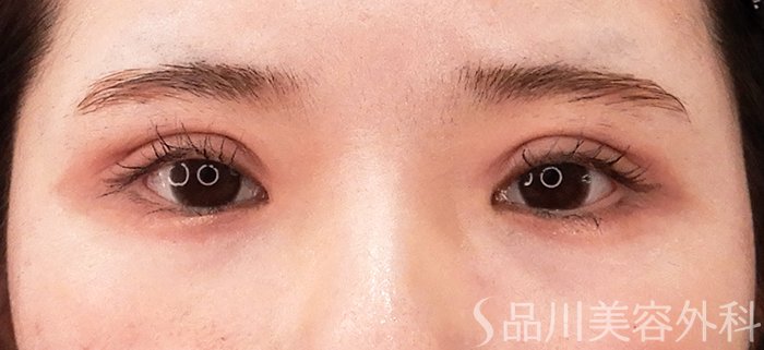 症例NO.62185のAFTER写真