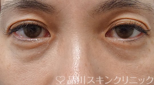 症例NO.63393のAFTER写真