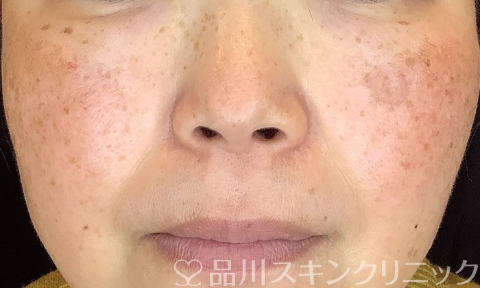 症例NO.73921のBEFORE写真