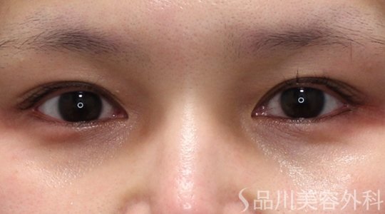 症例NO.75188のBEFORE写真
