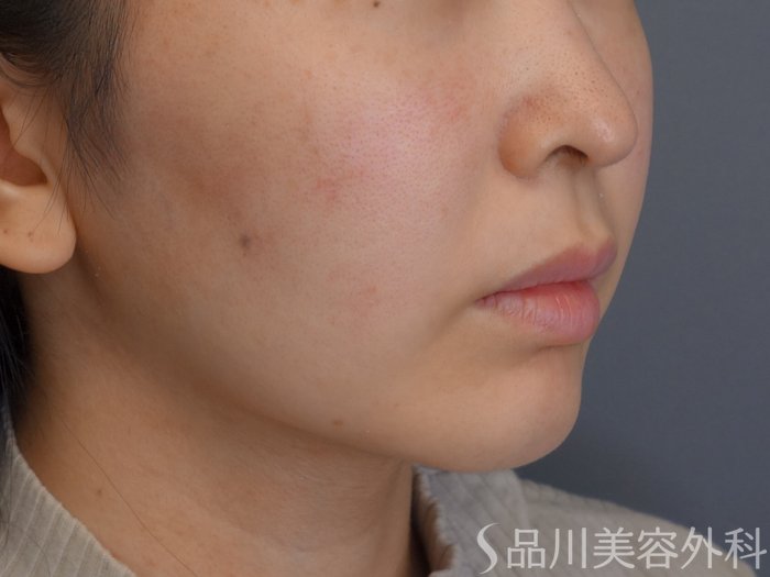 症例NO.74151のBEFORE写真