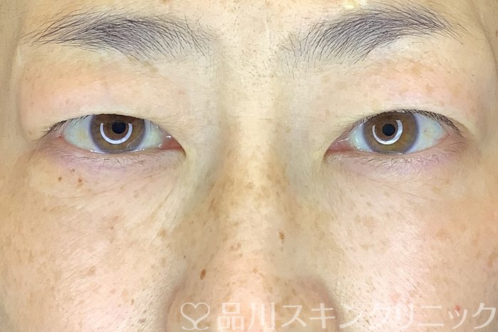 症例NO.63974のBEFORE写真